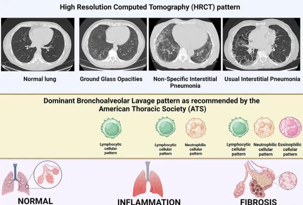 تفاوت های HRCT و CT معمولی در بیماری های بینابینی ریه؛ چرا نتیجه ها همواره یکی نیستند؟