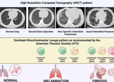 تفاوت های HRCT و CT معمولی در بیماری های بینابینی ریه؛ چرا نتیجه ها همواره یکی نیستند؟